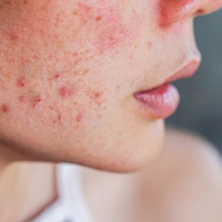 Understanding Acne: A Comprehensive Overview